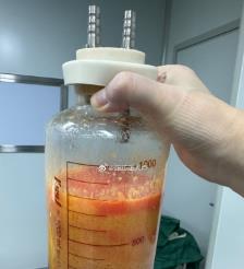 扬中水动力吸脂手术要做多久？
